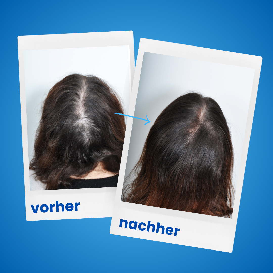 1x ShinyHair Haarwuchsbooster
